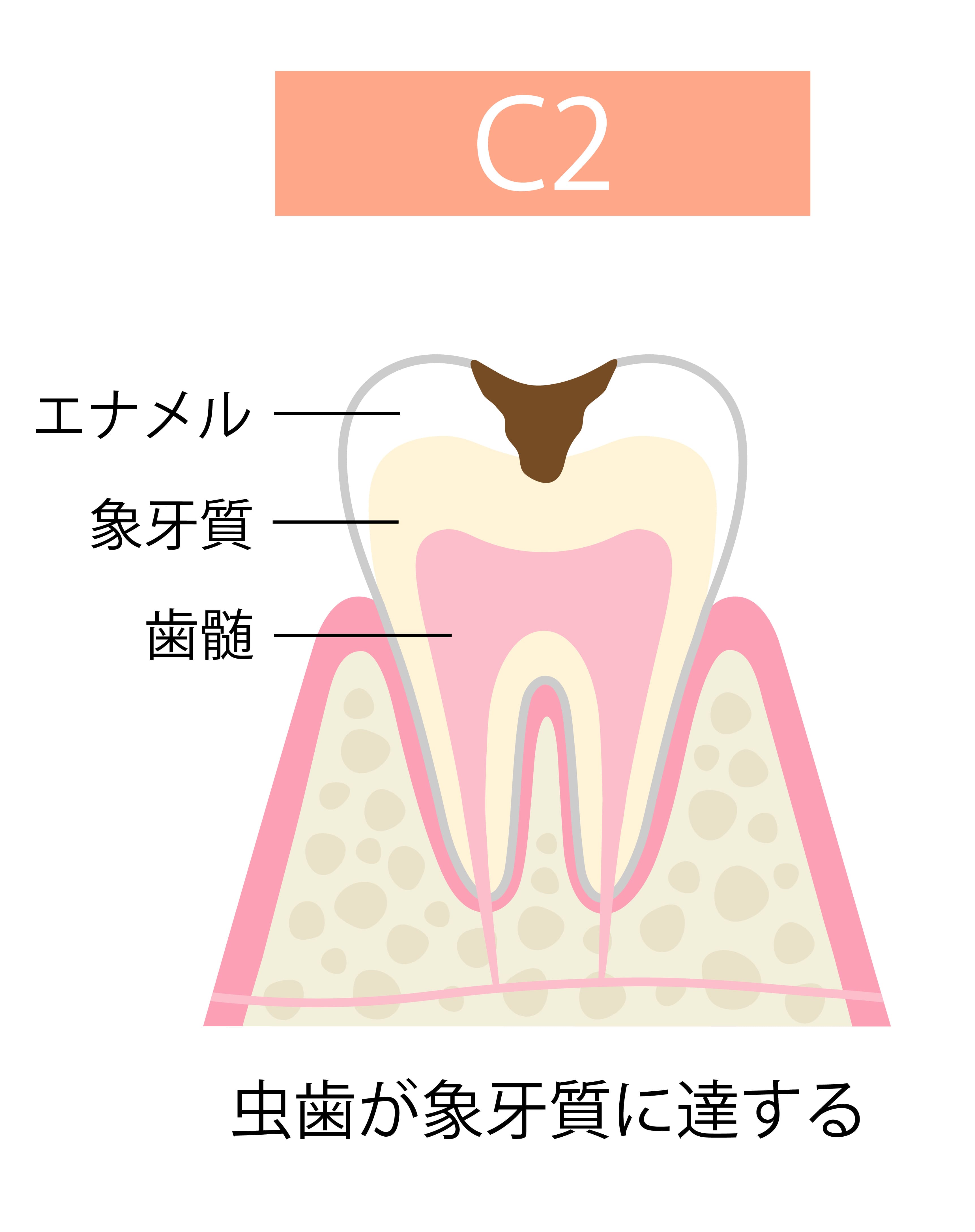 cavity