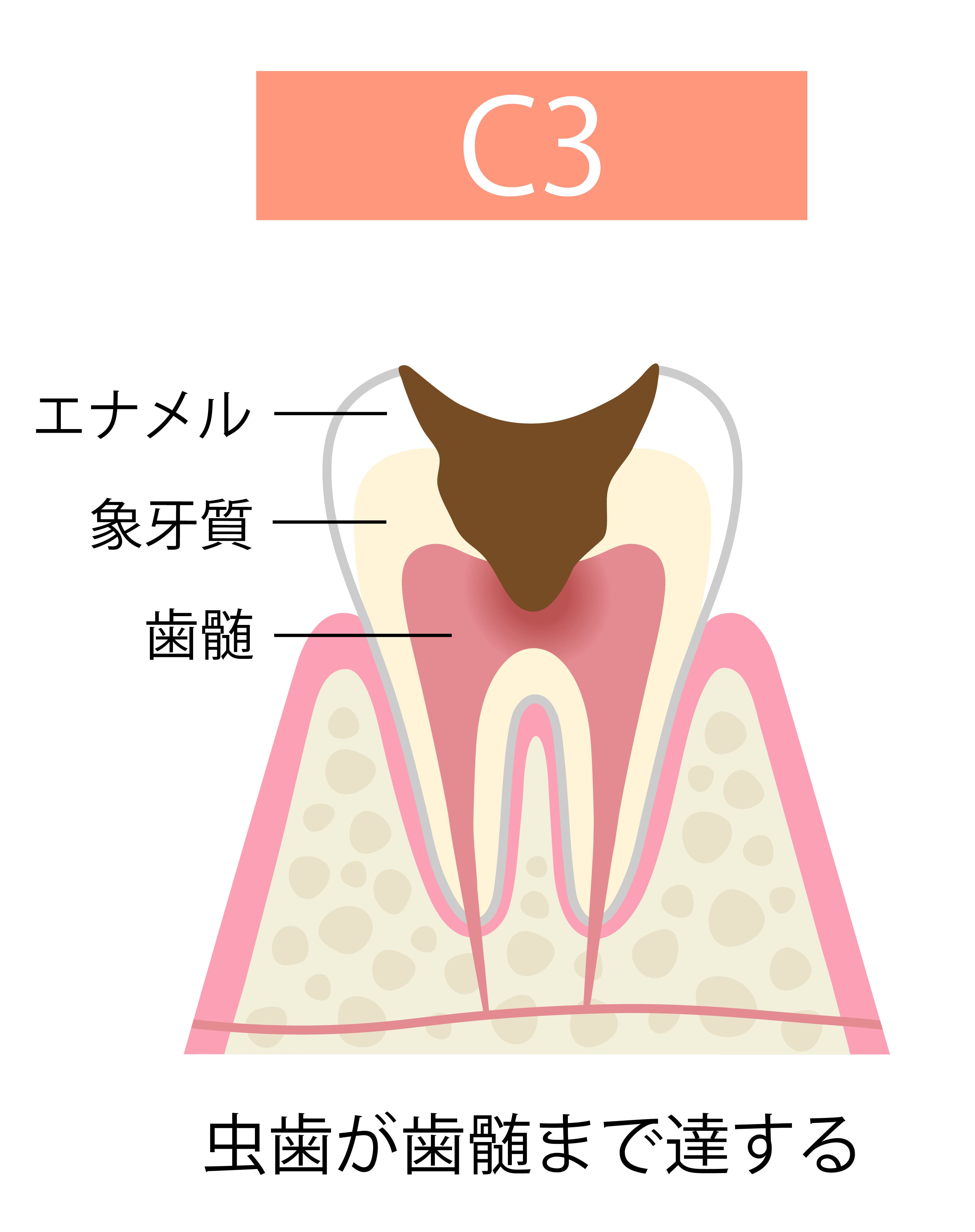 cavity