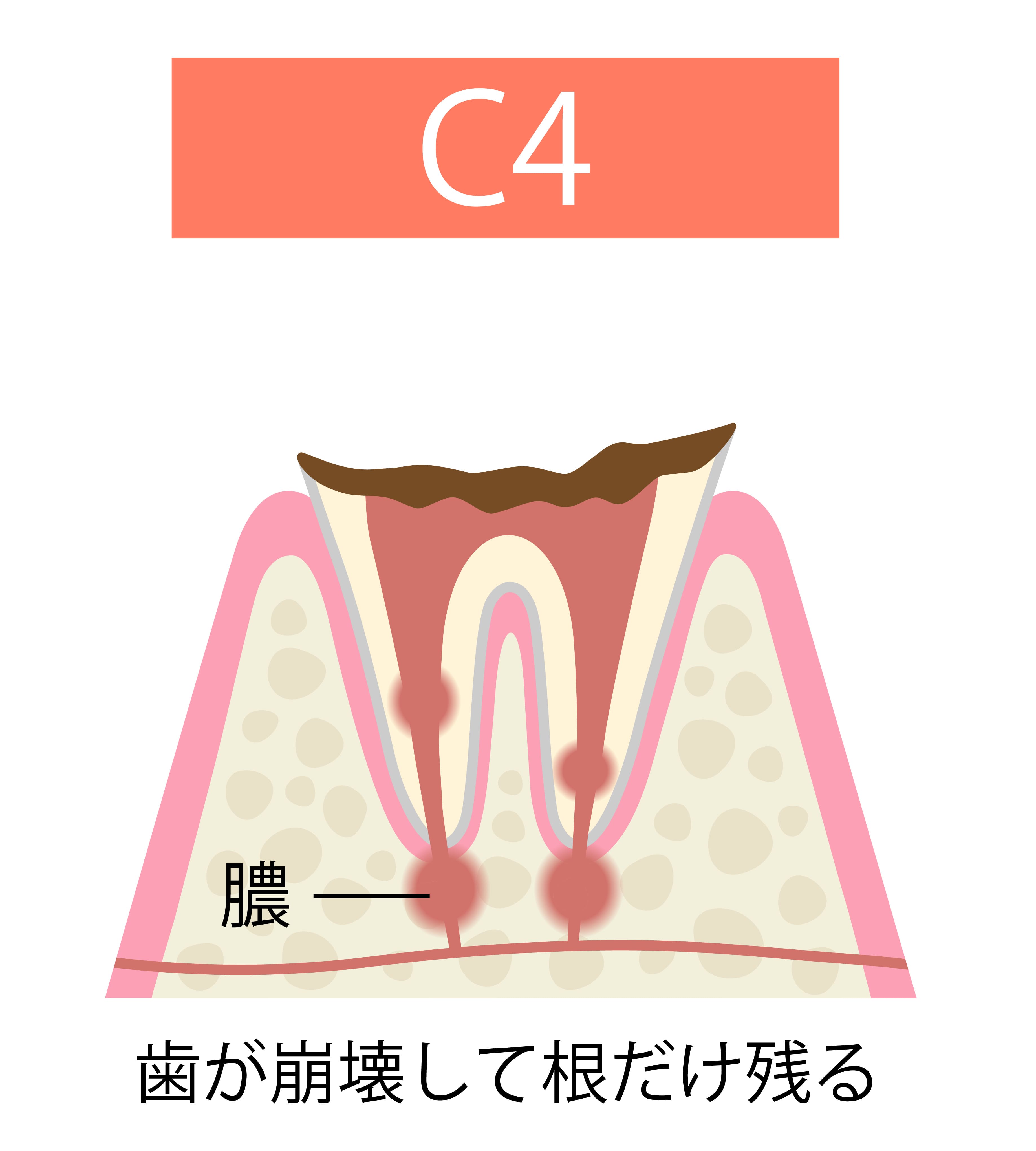 cavity
