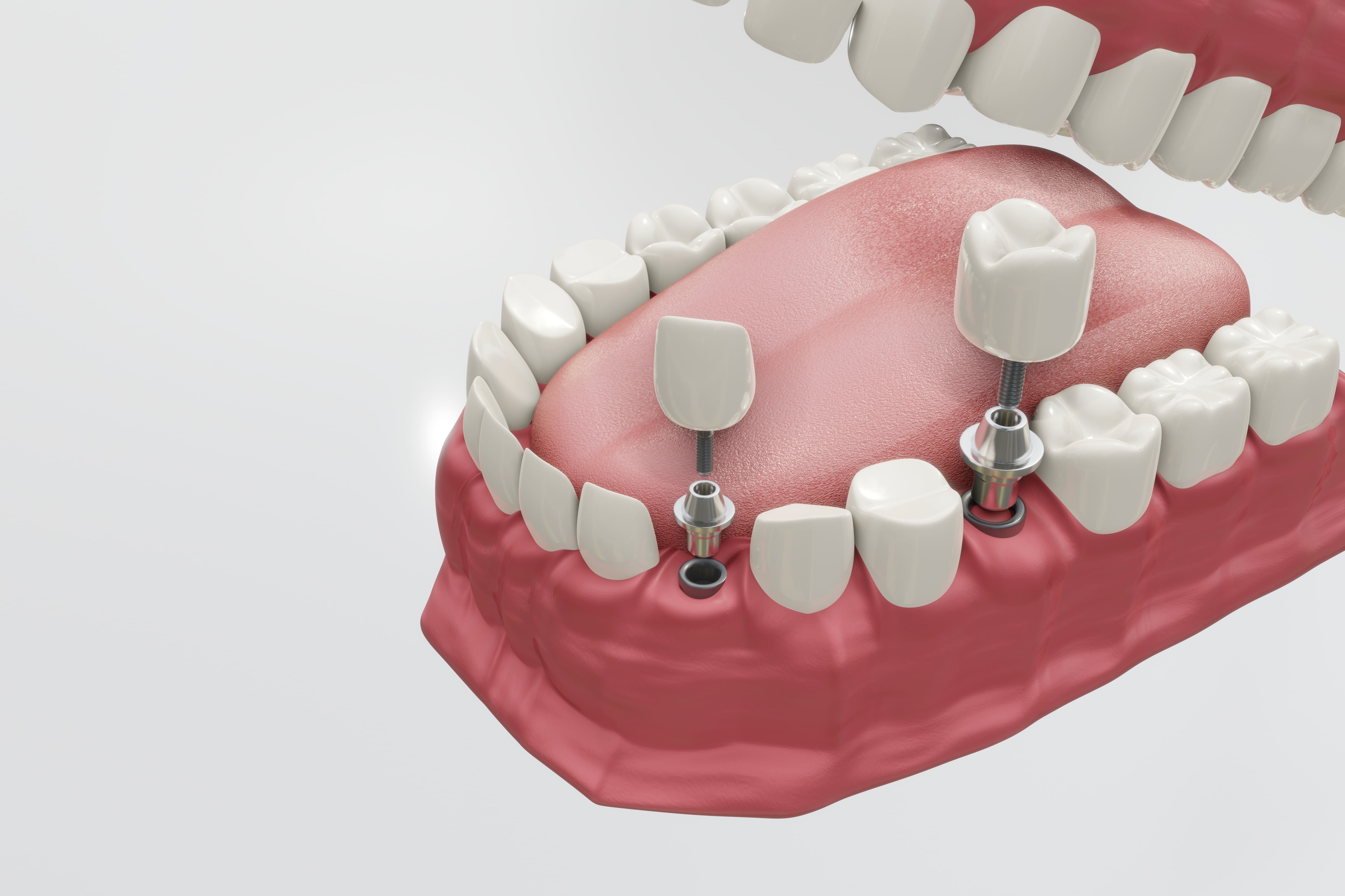 implant
