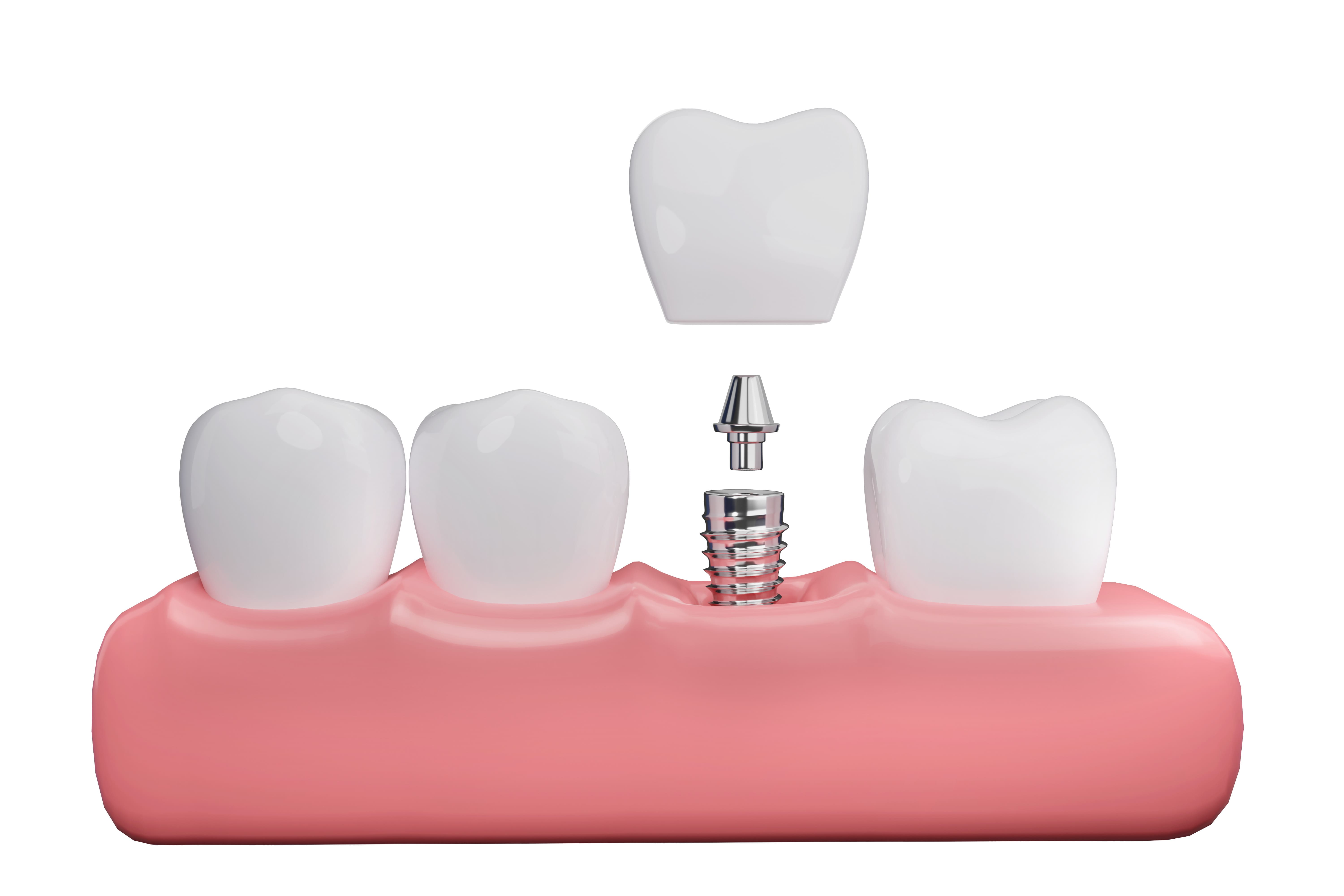 implant