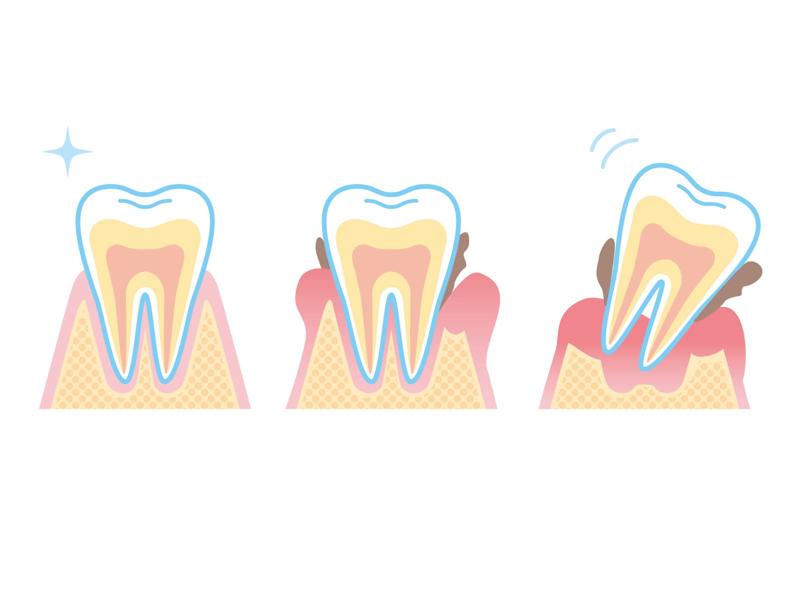periodontal-disease