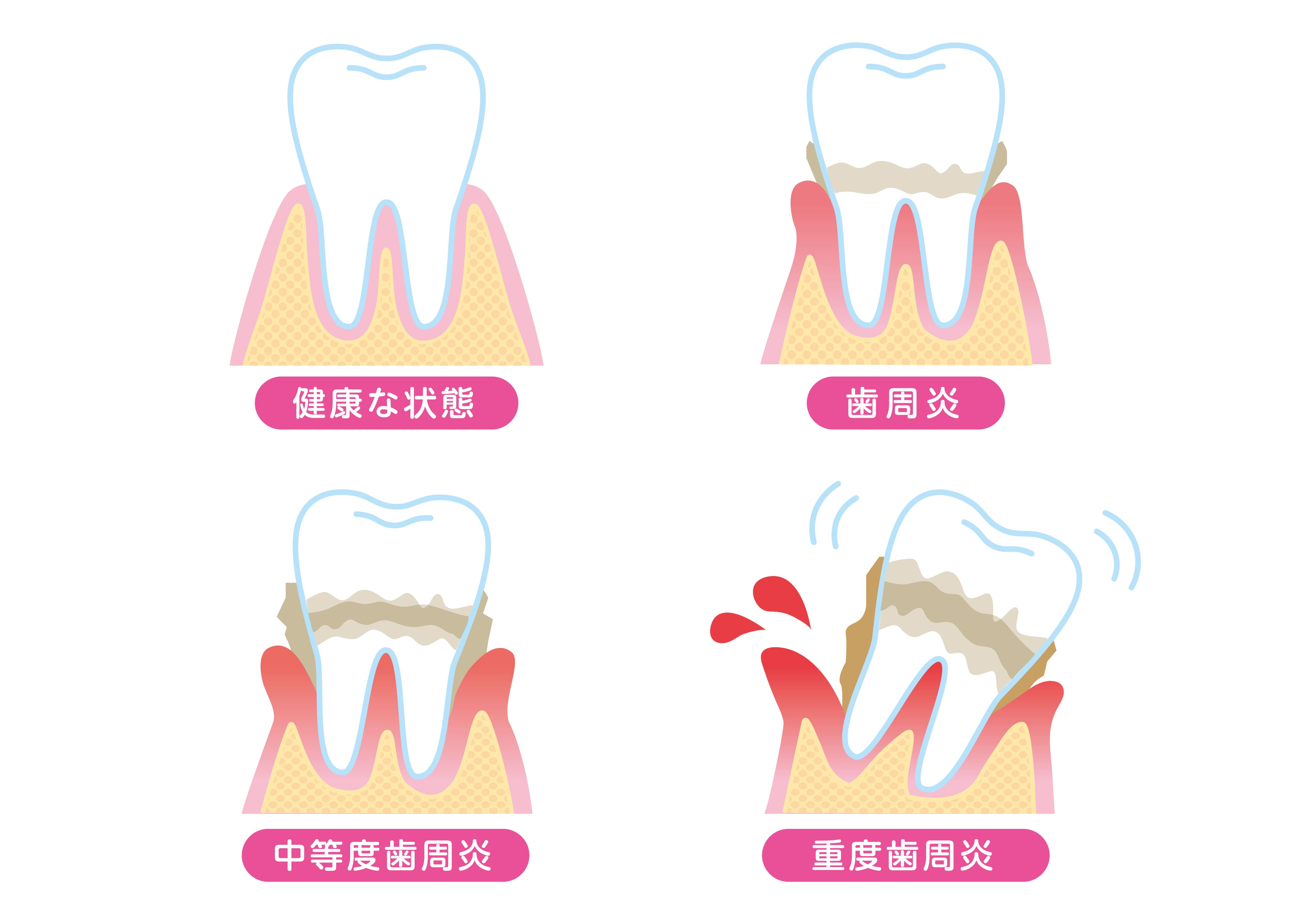 periodontal-disease