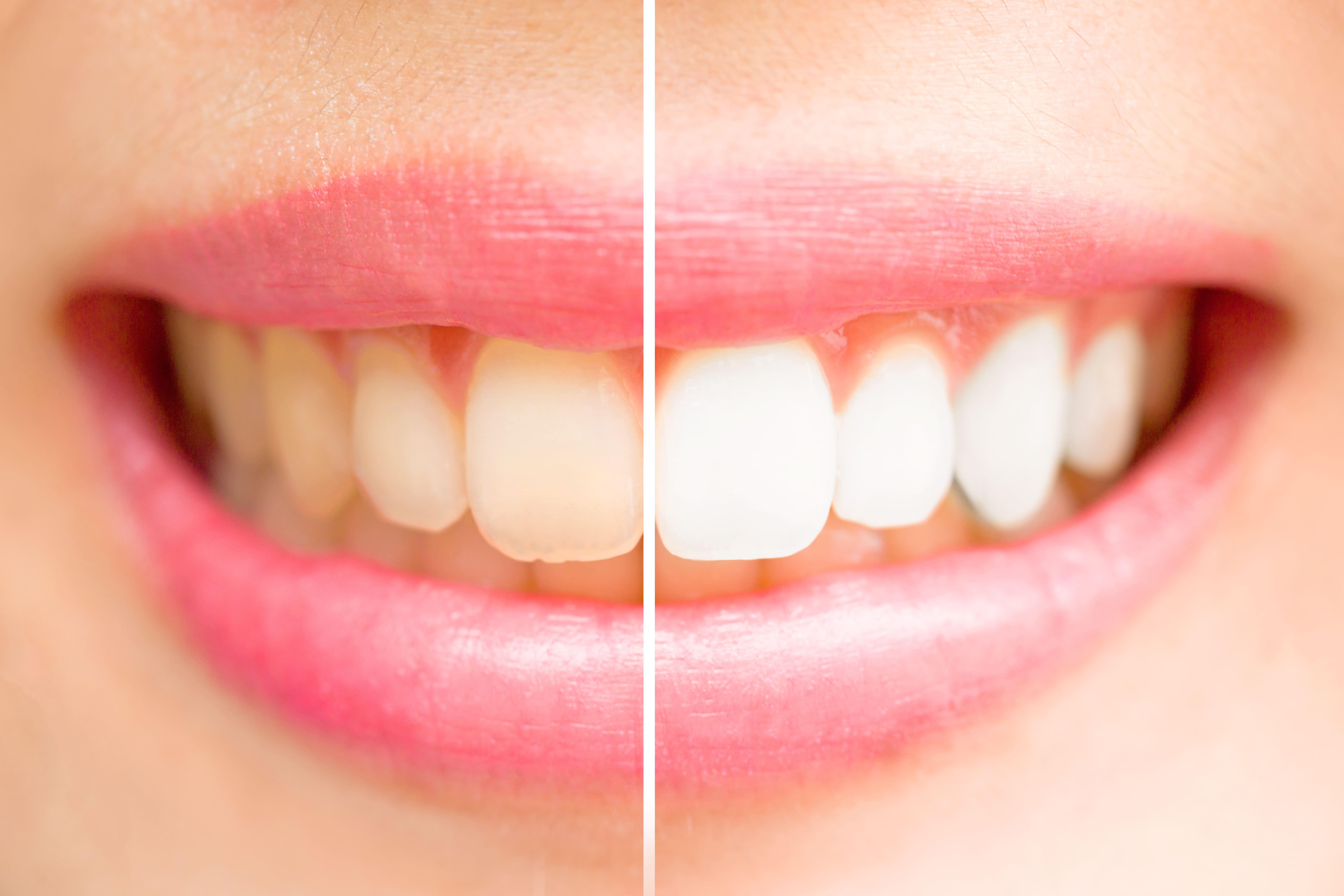 whitening